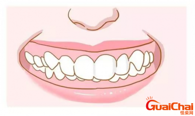 ​深覆合和地包天是什么样子？需要进行牙齿矫正吗？